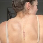 Emma Verran sa podelila o strach z melanómu na Instagrame, aby povzbudila mladých Aussov, aby chránili svoju pokožku