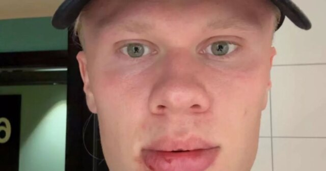 Erling Haaland požaduje stehy po celebrite „napísaných“ v fanatickom zranení tváre 

