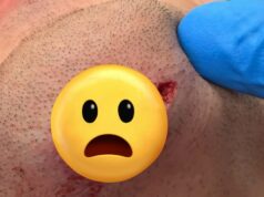 Ricky Simon trpí brutálnym porezaním brady na UFC Vegas 111 Ricky Simon trpí brutálnym porezaním brady na UFC Vegas 111