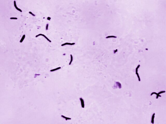 Tuberkulóza minulý rok zabila 1,23 milióna ľudí, tvrdí WHO | Tuberkulóza minulý rok zabila 1,23 milióna ľudí, tvrdí WHO | Správy Svetovej zdravotníckej organizácie