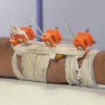 Lekári z Gazy používajú 3D technológiu na záchranu končatín rozbitých Izraelom pred amputáciou | Správy o konflikte medzi Izraelom a Palestínou