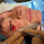 Moderátorka TNT Sports Laura Woodshasová prezradila strašné zranenie oka, ktoré utrpela na romantickom úteku so svojou snúbenicou Adamom Collardinom v roku 2024