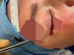 Laura Woods zdieľa grafické obrázky hororových zranení tváre po šialenej nehode Laura Woodsová