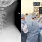 Populárny veterán WWE mal pred 8 týždňami „2úrovňovú výmenu krčnej platničky“.