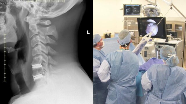 Populárny veterán WWE mal pred 8 týždňami „2úrovňovú výmenu krčnej platničky“.
