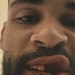 Anglický futbalista Ruben Loftus-Cheek odhalil hrozné zranenia po strašidelnom strete|Futbal|Športová aktivita